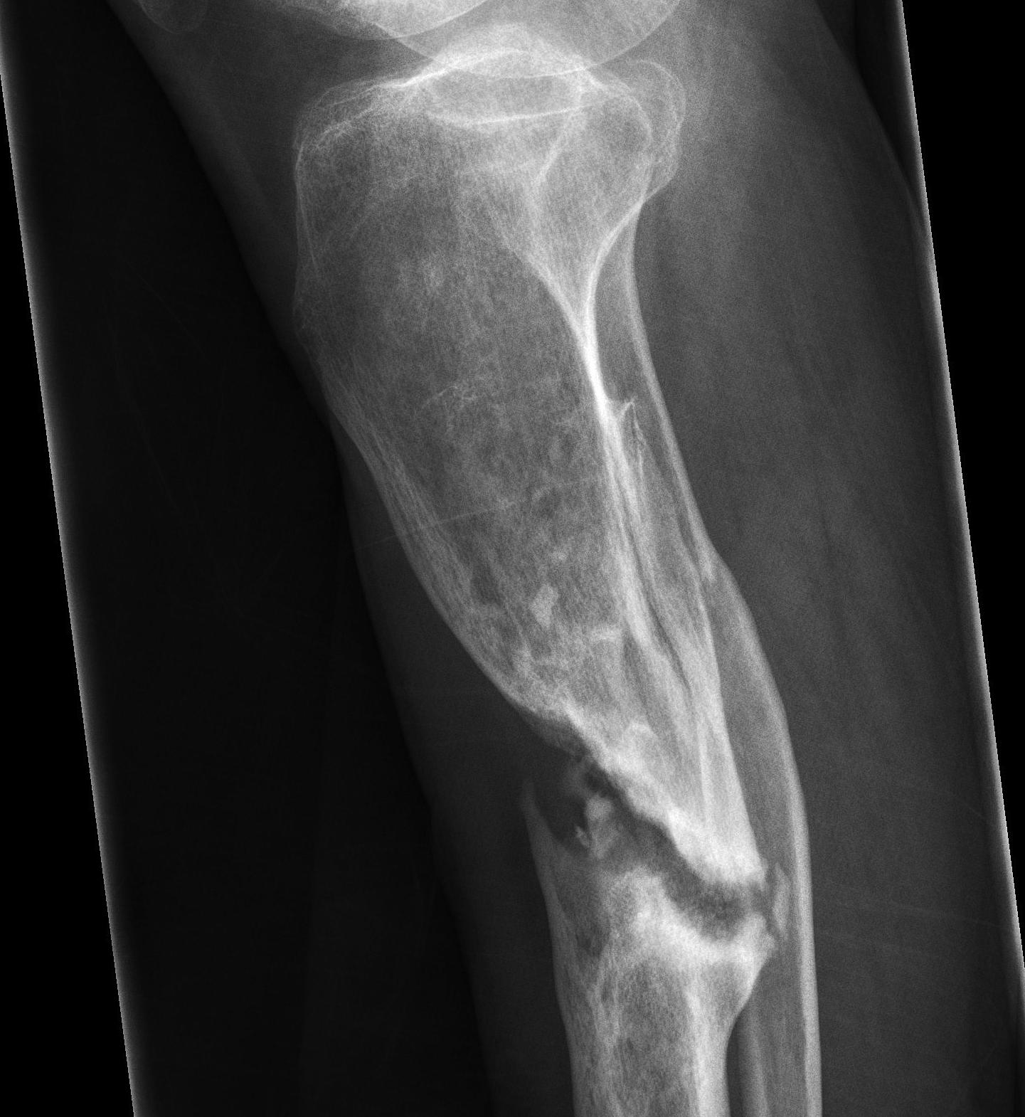 Tibial Oligotrophic Nonunion